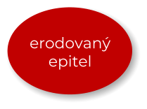 erodovaný epitel