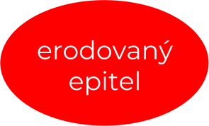 erodovaný epitel